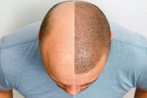 Composición aportada de una vista superior con dos aspectos del cabello separados por una línea vertical.