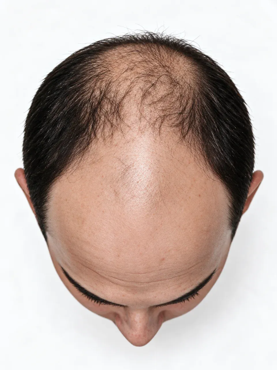 Vista superior de una cabeza masculina con cabello disperso en la parte frontal y superior.