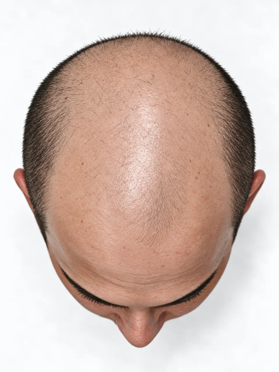 Vista superior de una cabeza masculina con una superficie superior amplia despejada y cabello corto alrededor.